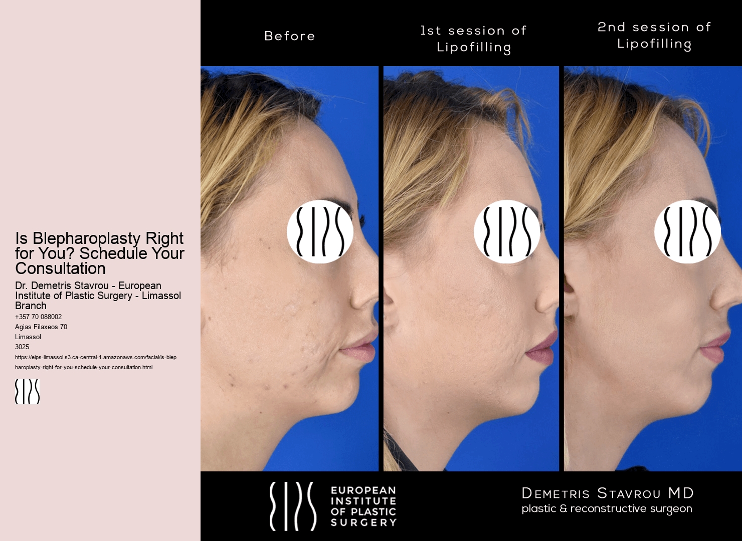 Is Blepharoplasty Right for You? Schedule Your Consultation