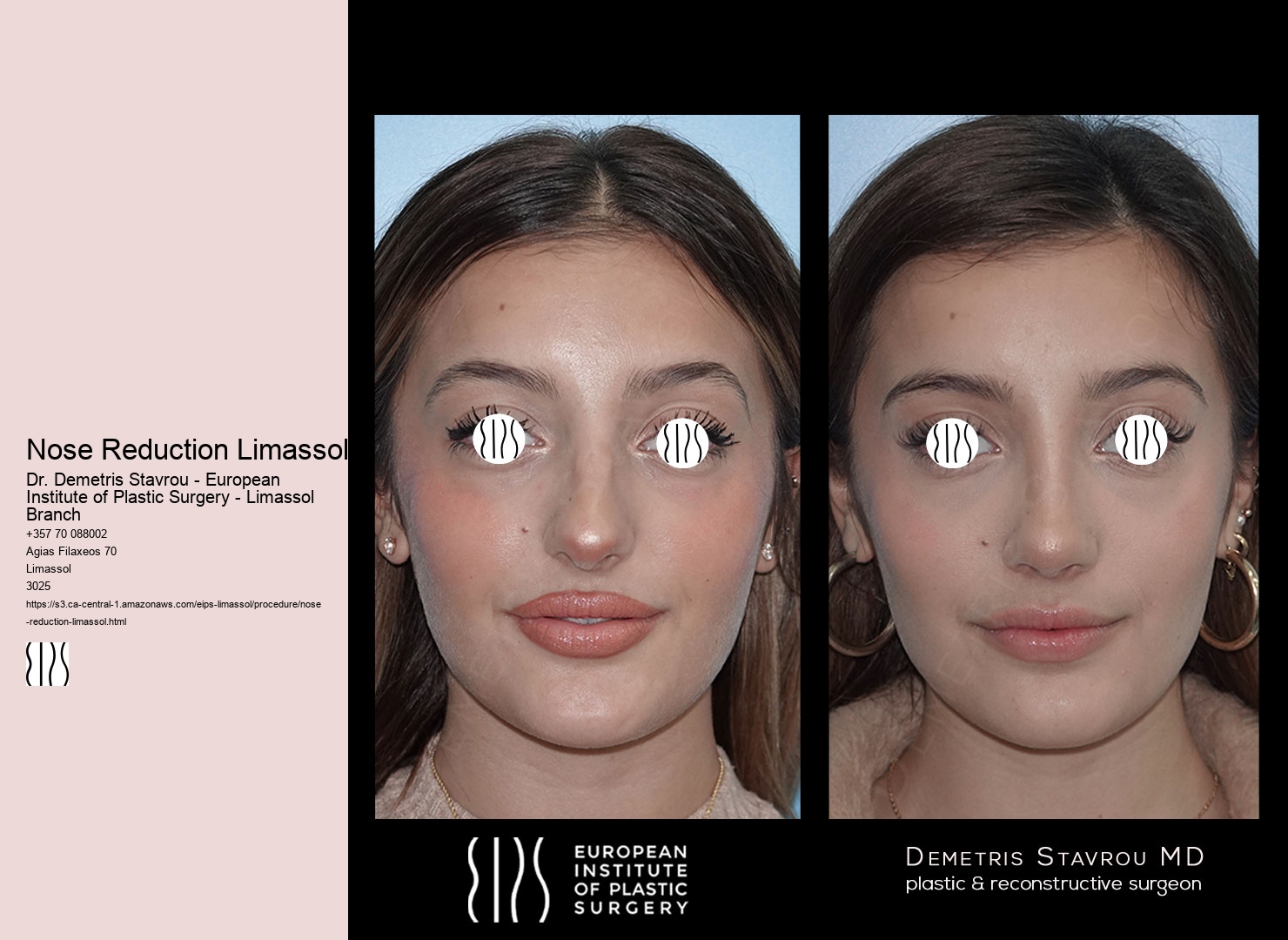 Nose Reduction Limassol