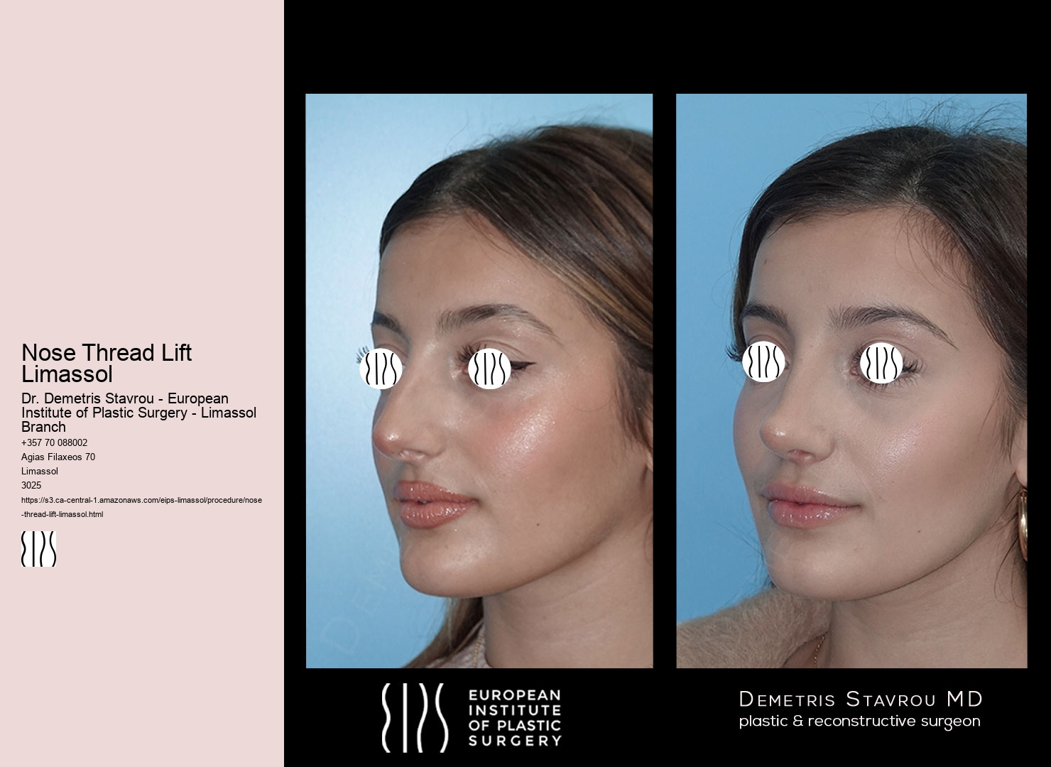 Nose Thread Lift Limassol