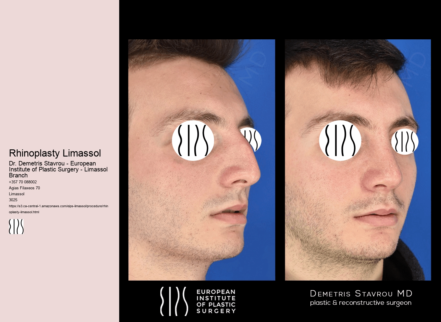 Rhinoplasty Limassol