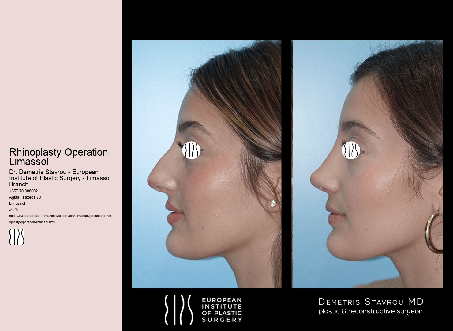 Rhinoplasty Operation Limassol