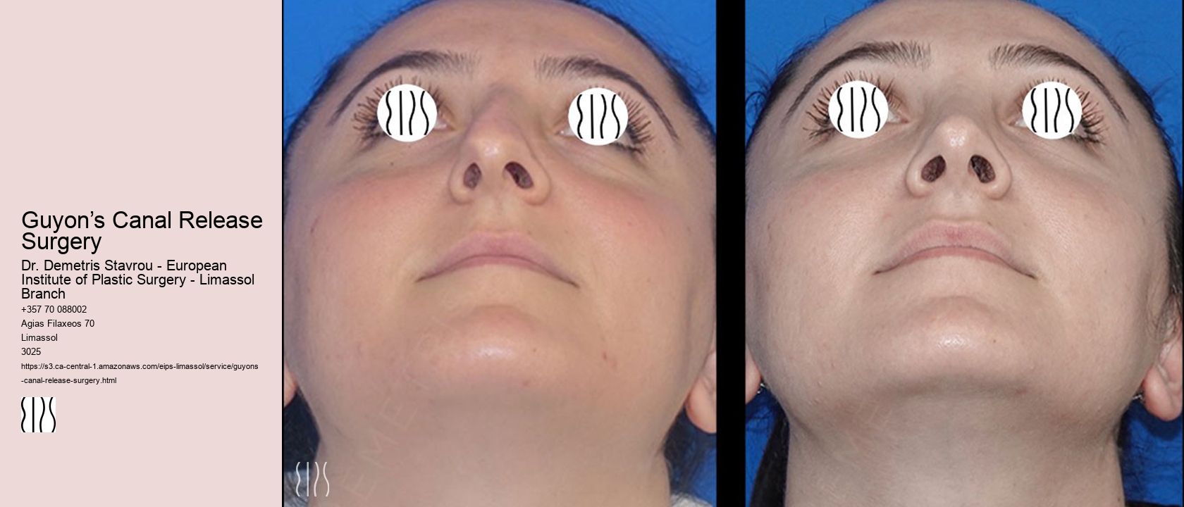 Guyon’s Canal Release Surgery