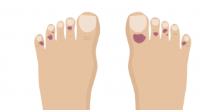علائم COVID toes چیست؟