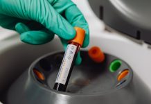 پیشبینی خطر سکته مغزی براساس گروه خونی