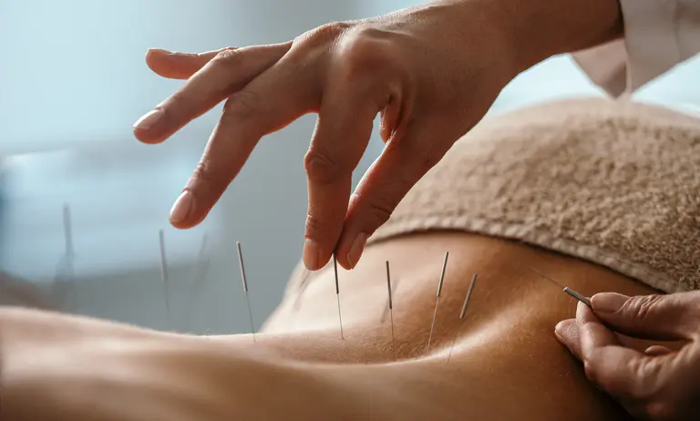 acupuncture therapy acupuncturist
