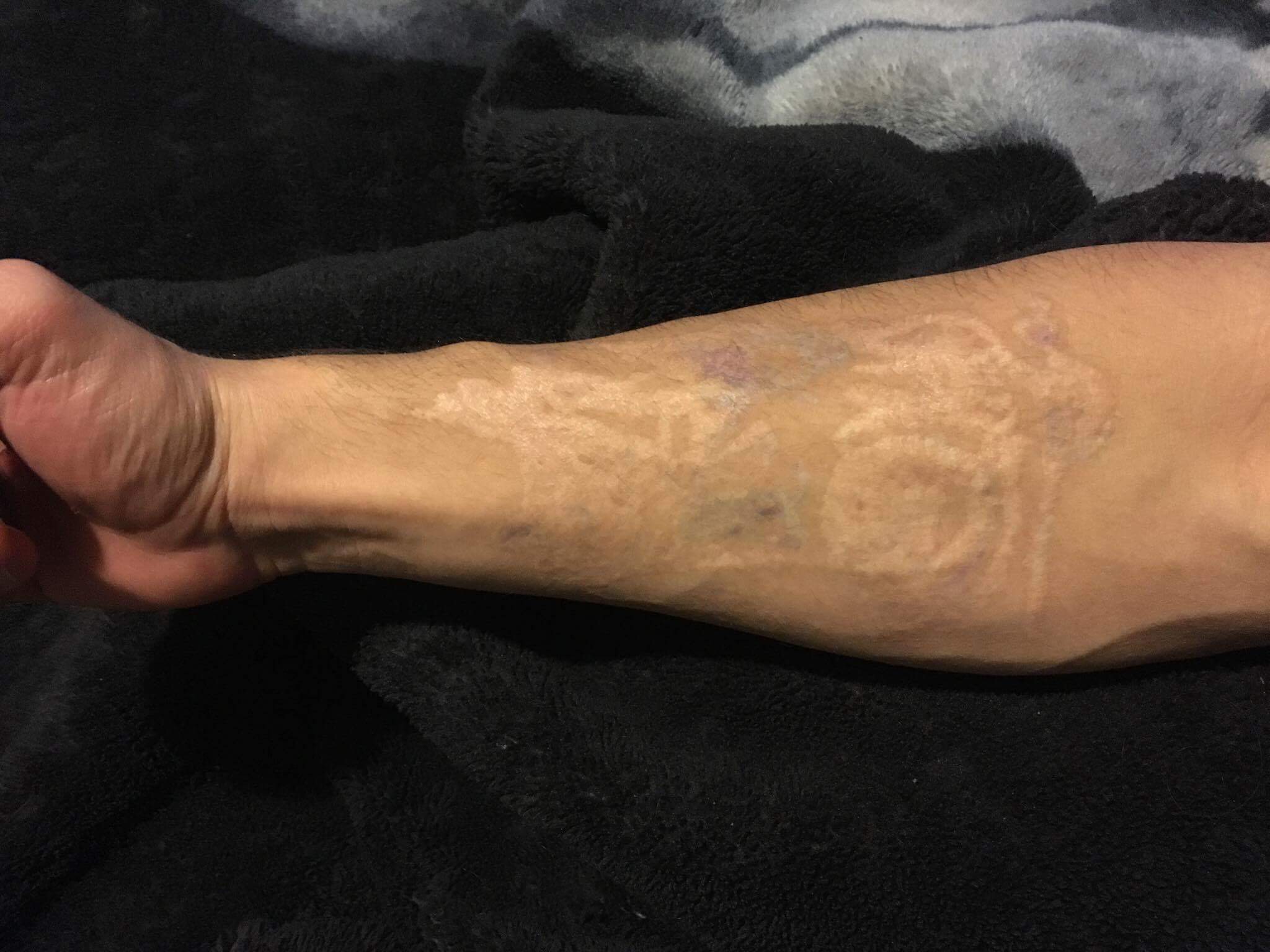 Le détatouage, une pratique sans encadrement