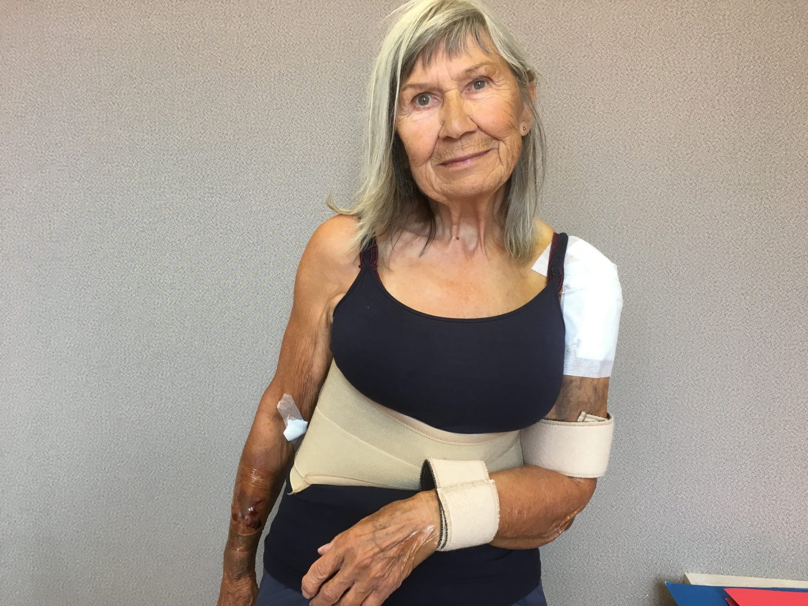 Une victime d’accident avec un cycliste lance un appel à la prudence