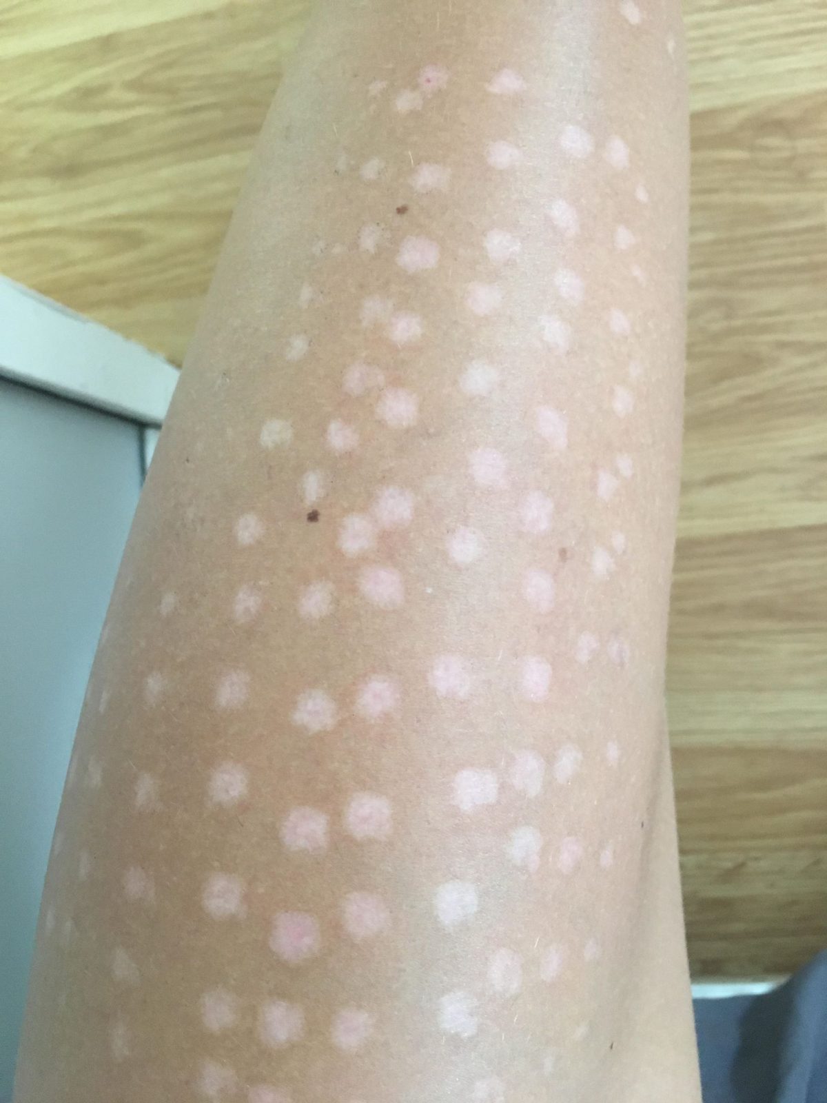 627 ans pour indemniser une femme brûlée par un traitement au laser