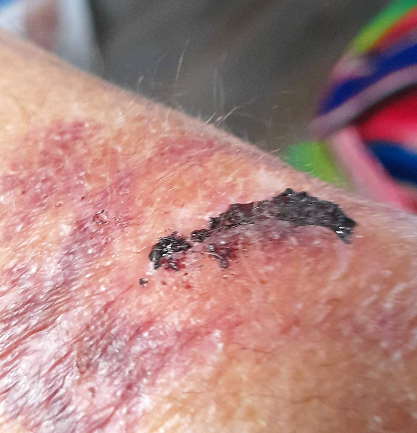 Il se blesse en allant porter ses livres à la bibliothèque