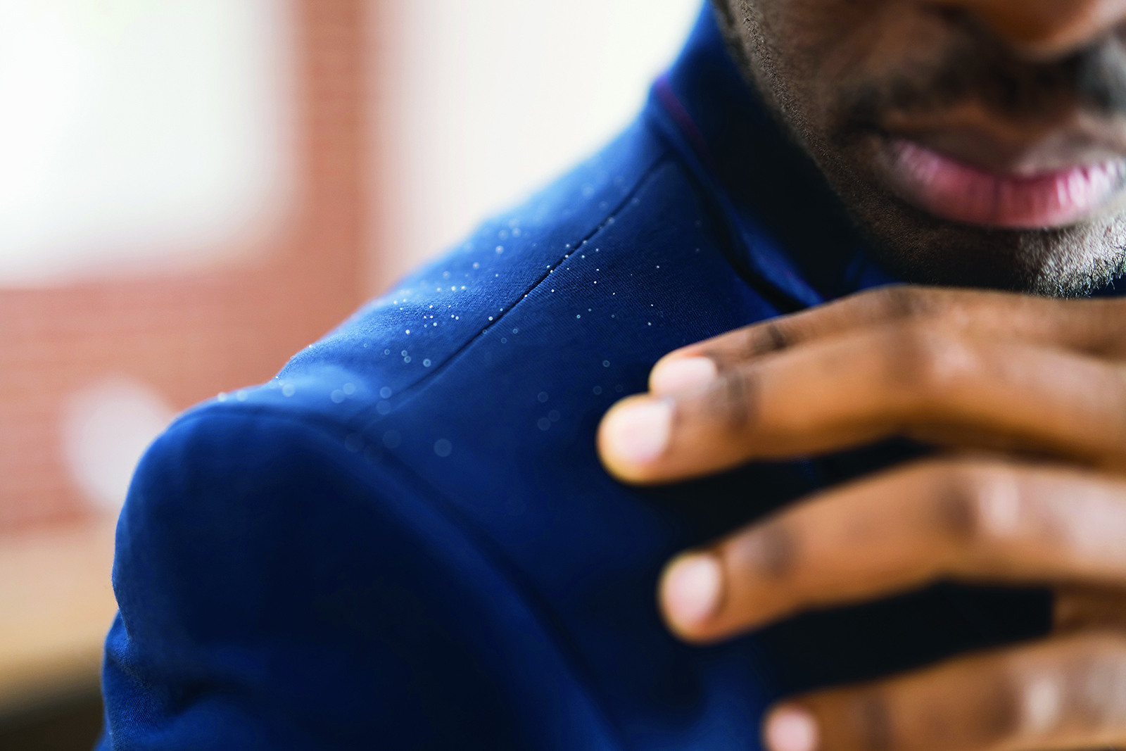 3 conseils pour combattre les pellicules
