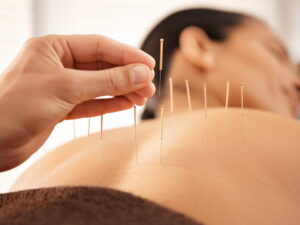 Acupuncture needles placed along a person’s back during treatment