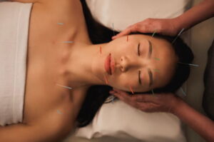 Acupuncture needles placed along a person’s back during treatment