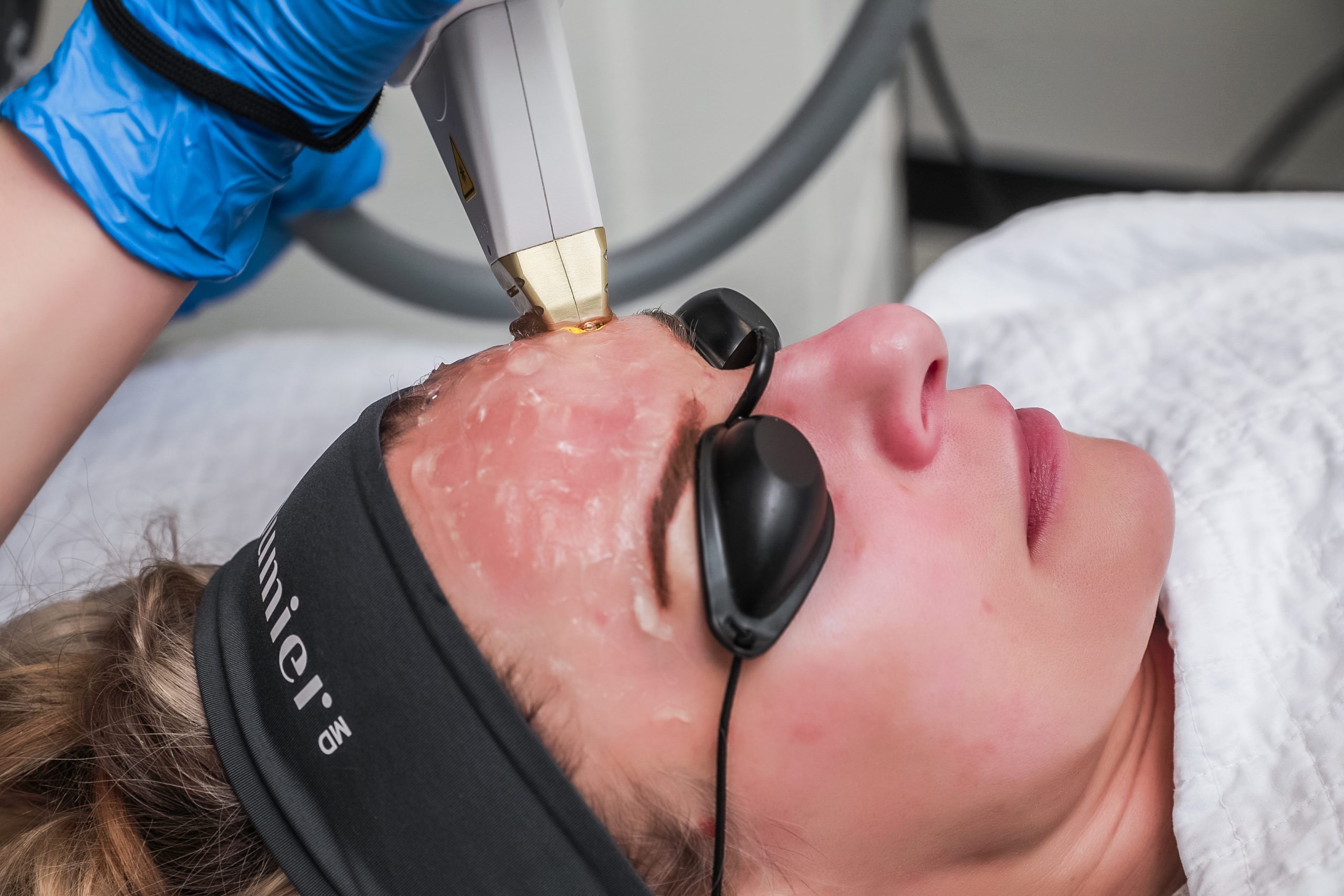 Intense Pulsed Light IPL Rejuvenating Treatment for Face Body