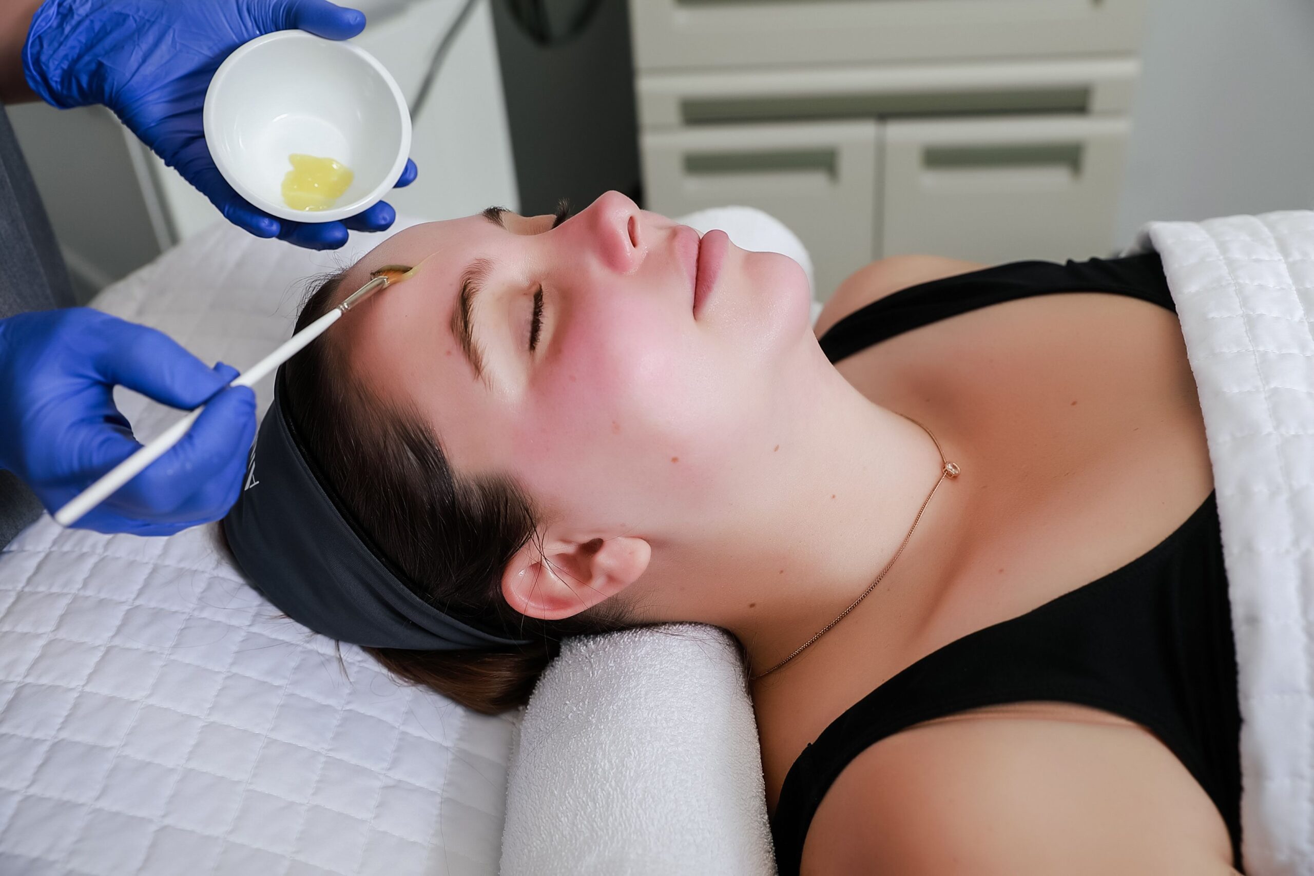 chemical peels